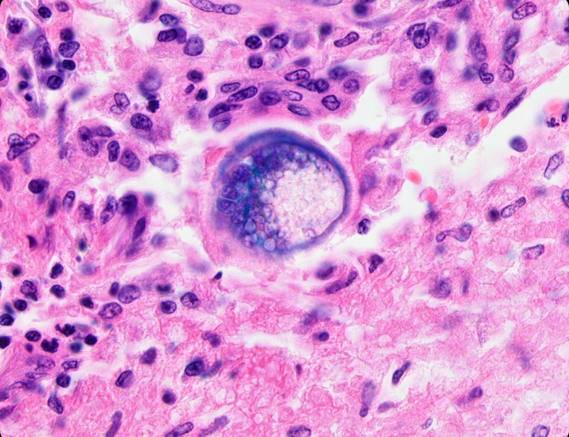 #Neuropath day 29 - leap year bonus for my month long #neuropathology blitz! This is from one of the most impressive #autopsy brains I have ever seen. What is this critter causing so much havoc in the #brain? Hint: see the pinned tweet on my profile.