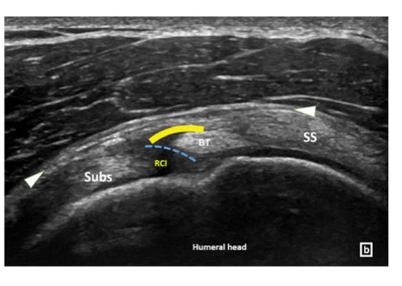 ECOGRAFÍA MUSCULOESQUELÉTICA Y HOMBRO

¿Cómo evaluamos ecográficamente el intervalo rotador y los tendones adyacentes en hombros con movimientos restringidos?

En este hilo te lo contamos 👇🏻🧵