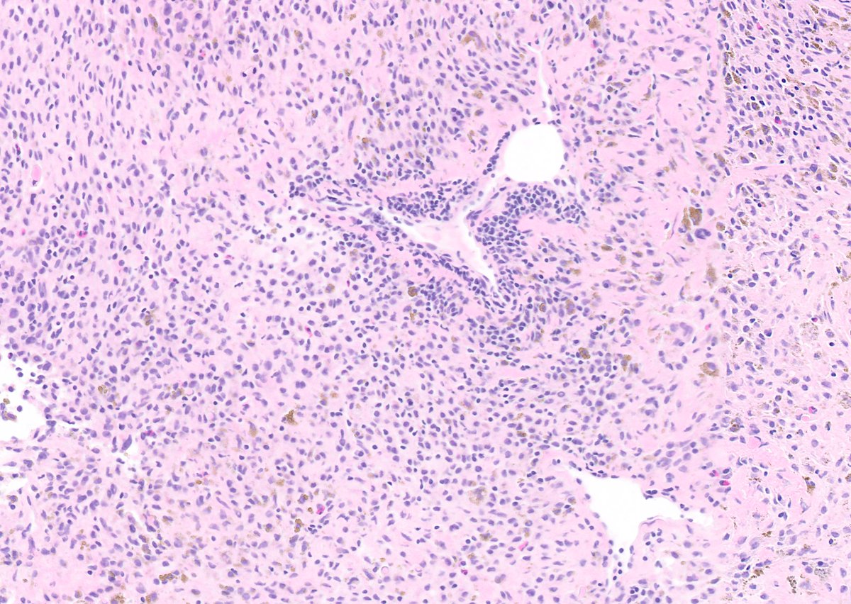 This is 'cutaneous' syncytial myoepithelioma...of bone! @JMcMahonG with @SintawatWang recognized that these morphologically distinctive tumors occur in diverse anatomic locations, including bone. pubmed.ncbi.nlm.nih.gov/37548750/ They have recurrent EWSR1::PBX3 fusions too! #BSTpath