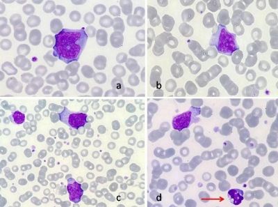 #NuevaImagendelmesGECH Niño de 14 años con sme febril, adenopatías, hepatoesplenomegalia y linfocitosis ¿Qué diagnóstico es más probable con los hallazgos en el frotis de SP? A.LLA B.Mononucleosis inf C.Linfoma B alto grado D.LMMC juvenil Patrocinada por Cellavision