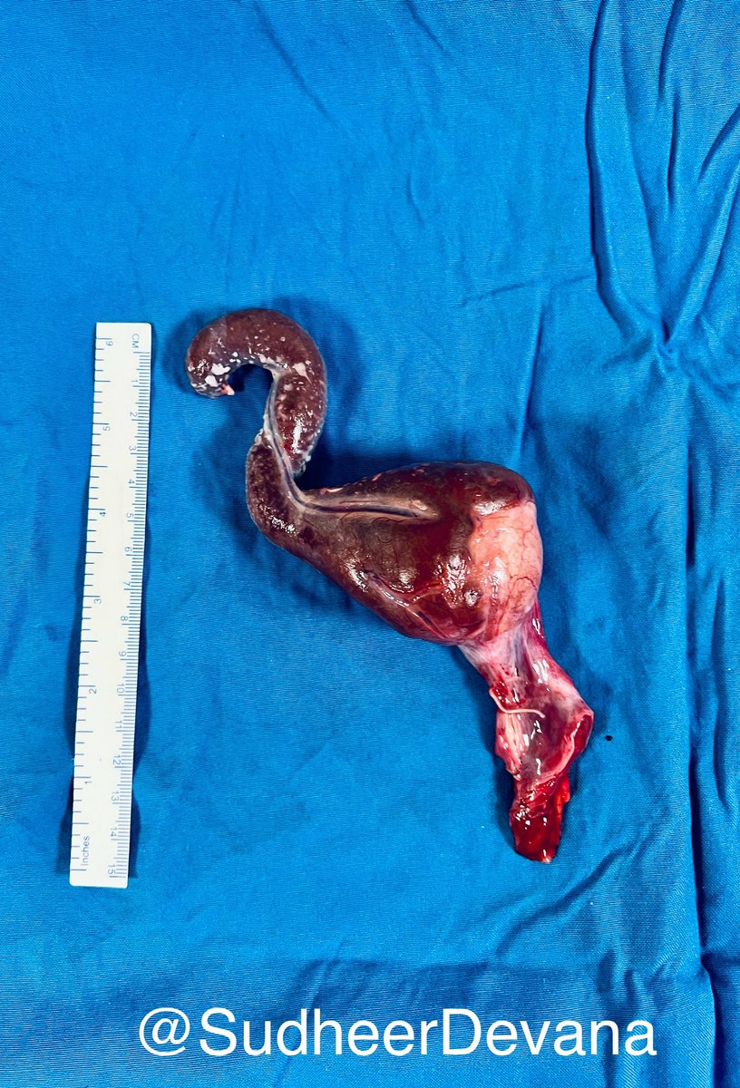 Sometimes #tumors attain interesting shapes. Tumor in an undescended testis looking like an elephant head. #urooncology #testicularcancer 😊