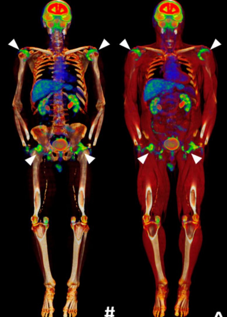 Proud to introduce Rheumatology Advances in Practice @rheumjnl 1st atlas review #PolyMyalgiaRheumatica on PET/CT 👉🏾academic.oup.com/rheumap/articl… Do you have lots of images that define disease characteristics? Consider submitting an atlas review ✍️🏾academic.oup.com/rheumap/pages/…