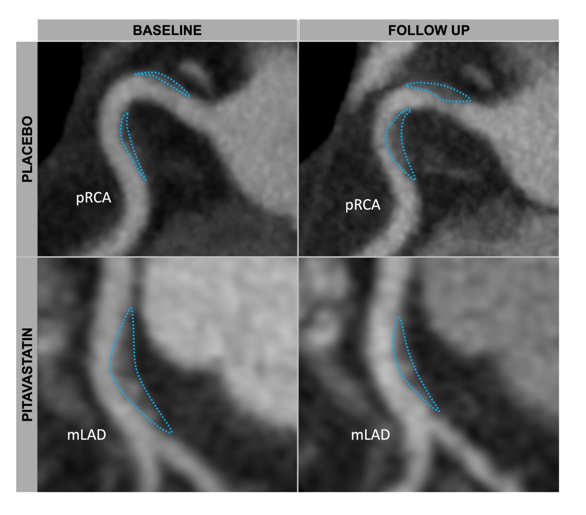 Largest RCT of plaque changes on CT in response to drug. @CIRC_MGH