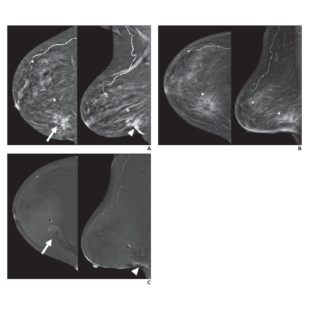 CEM may be used for follow-up imaging of patients after breast cancer cryoablation, having several advantages for this purpose compared with alternate imaging modalities.ajronline.org/doi/10.2214/AJ…