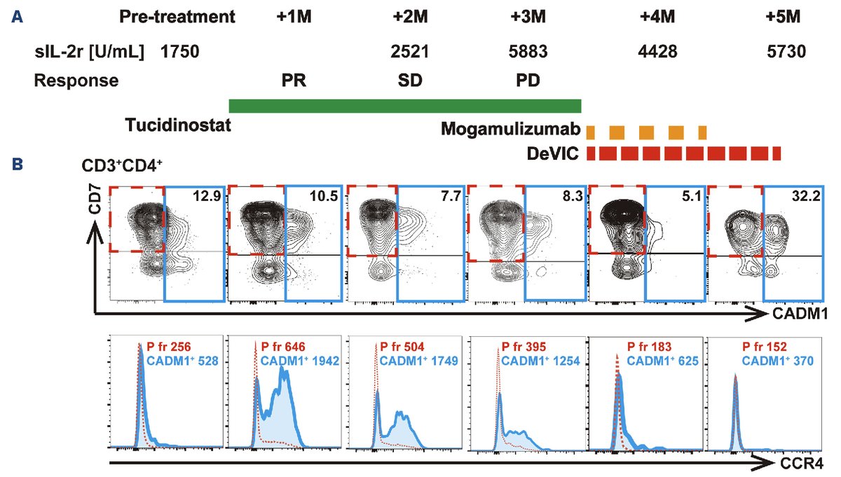 Clinicians can personalize their approach and select the most appropriate histone deacetylase inhibitor to enhance or maintain #CCR4 expression in adult #T-cell #leukemia/lymphomaCells haematologica.org/article/view/h…