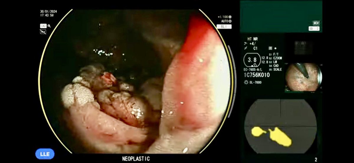 Aquilant Endoscopy (@aquilant_endo) on Twitter photo Did you see the #Fujifilm Scale Eye Colonoscope being discussed today at <a href="/LLEndoscopy/">LondonLive Endoscopy 2022</a> by <a href="/EdSeward3/">Ed Seward</a>! Used to accurately measure polyp size & assisted by #CADEYE AI to characterise lesions.
Follow <a href="/Aquilant_Endo/">Aquilant Endoscopy</a> for more information #Healthcare21 #Aquilant Did you see the #Fujifilm Scale Eye Colonoscope being discussed today at <a href="/LLEndoscopy/">LondonLive Endoscopy 2022</a> by <a href="/EdSeward3/">Ed Seward</a>! Used to accurately measure polyp size & assisted by #CADEYE AI to characterise lesions.
Follow <a href="/Aquilant_Endo/">Aquilant Endoscopy</a> for more information #Healthcare21 #Aquilant