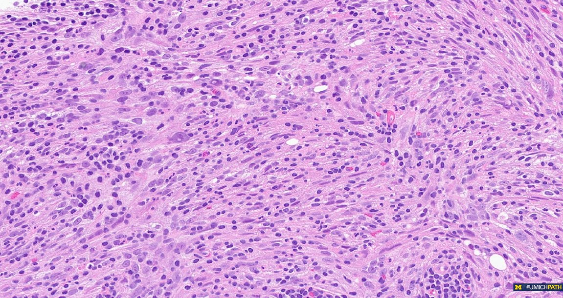 Michigan Pathology (@umichpath) on Twitter photo 🔬 #COTW from <a href="/sarahnfarran/">Sarah Farran, MD, MPH</a>!
67M with a history of CLL/SLL and a new swollen left neck lymph node near site of original diagnosis. What is this entity and what immunostains can help establish the diagnosis? #UMichPath 🔬 #COTW from <a href="/sarahnfarran/">Sarah Farran, MD, MPH</a>!
67M with a history of CLL/SLL and a new swollen left neck lymph node near site of original diagnosis. What is this entity and what immunostains can help establish the diagnosis? #UMichPath