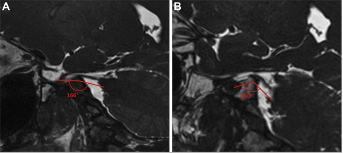 #NEUNew The Sagittal Angle of the Trigeminal Nerve at the Porus Trigeminus is a Radiologic Predictor of Surgical Outcome in Microvascular Decompression for Classical Trigeminal #Neuralgia bit.ly/3TkbmB0 by Branstetter and Sekula @PittRadiology @RushnaAli6 @CNS_Update