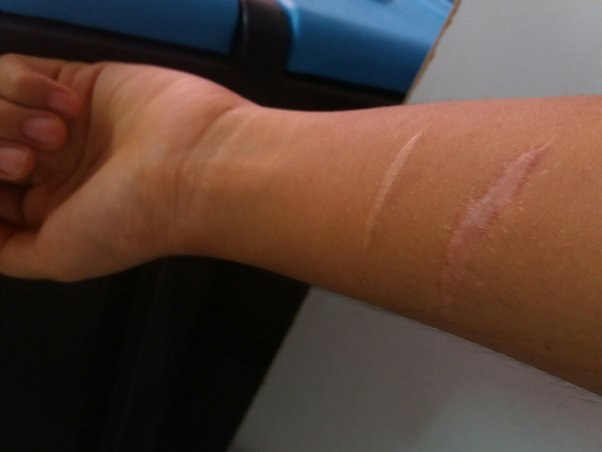 Today is Self Harm Awareness Day
Self harm is deliberating injuring oneself without any suicidal intent. Rarely however death can happen accidentally. The commonest form is applying cuts to the wrist and forearm. Some individuals report a sense of relief after the act. Patients