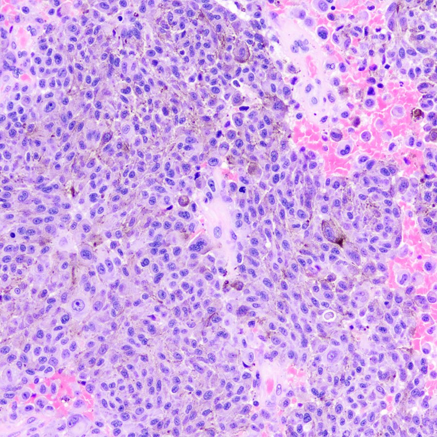 You can do immunostains to confirm, but what's the most likely diagnosis for this cerebellar lesion? #pathology #neuropath #PathTwitter