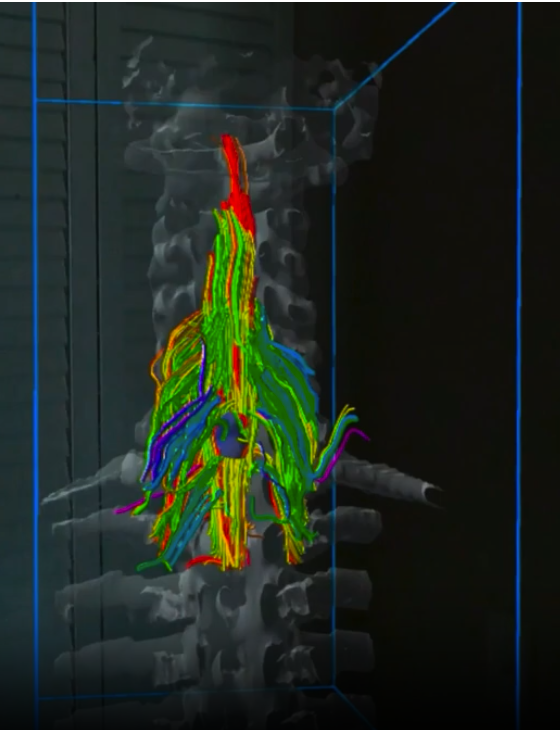AppliedRadiology (@applied_rad) on Twitter photo Sira Medical Nets FDA Clearance for Augmented Reality Surgical Planning Software
Learn more ➡️ bit.ly/3wBYXiQ
<a href="/siramedical/">Sira Medical</a>
#RadNews #HealthCare #AugmentedReality #PatientCare Sira Medical Nets FDA Clearance for Augmented Reality Surgical Planning Software
Learn more ➡️ bit.ly/3wBYXiQ
<a href="/siramedical/">Sira Medical</a>
#RadNews #HealthCare #AugmentedReality #PatientCare
