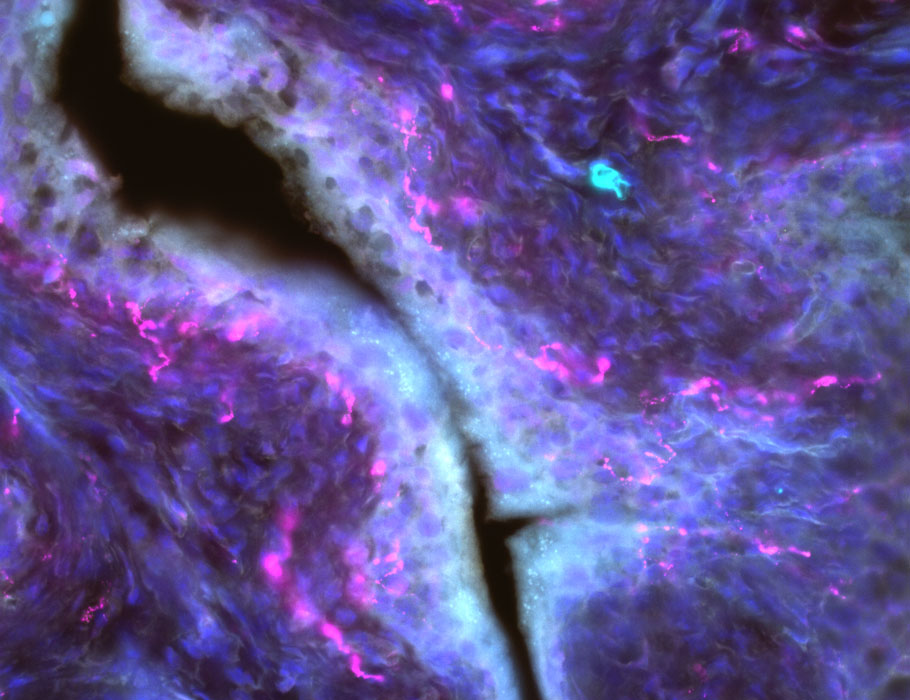 SciImmunology's tweet photo. Pelvic pain and incontinence may remain for patients recovering from recurrent #UTIs because of #MastCell crosstalk with nociceptive sensory nerves, suggests a new study involving patient samples and mouse models.
📄: https://t.co/tR8ySVZt5S @DukeMedSchool #rUTIs https://t.co/WPHmVlngTe