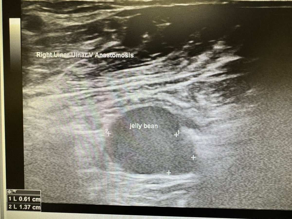 robshahverdyan's tweet photo. 5 years old ulnar to ulnar BD #WavelinQ #endoAVF #pAVF with intended brachial vein outflow and transposition - with 0 interventions - in a patient with previous failed several accesses and no superficial veins available. #VascularAccessCenter #Hamburg #ESKD https://t.co/InPlmg2X3V