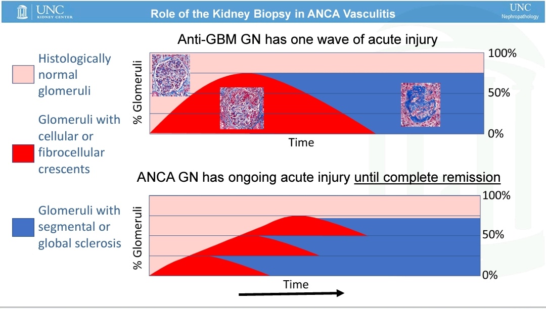 OmarMDork's tweet photo. ✅ Anti MBG tiene solo una "oleada" de lesión renal mientras que ANCA tiene múltiples oleadas hasta la remisión completa lo que perpetúa el daño https://t.co/g5HVWounIc