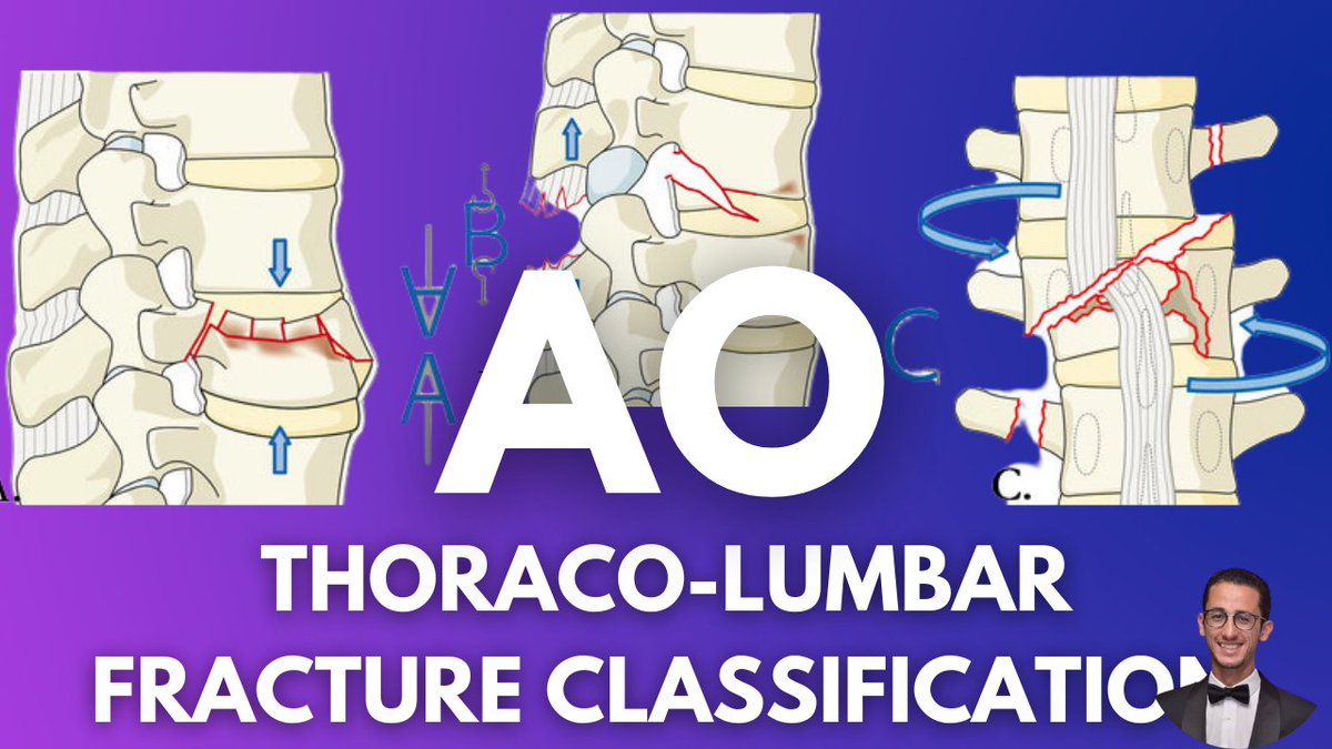 Mohamed Draz (@msdraz) on Twitter photo The AO classification for thoracolumbar fractures was always confusing to me, until I made this video to simplify it.
Watch the new video through the link
youtube.com/watch?v=tomY1B…
<a href="/neurosurgatlas/">Neurosurgical Atlas</a> <a href="/The_SBNS/">SBNS</a> <a href="/AliBaajMD/">Ali A. Baaj MD</a> <a href="/INSNeurosurgery/">Institute of Neurological Sciences</a> <a href="/e1v1m1/">BNTA</a> <a href="/drtintin99/">Kevin Tsang</a> <a href="/radiologytuts/">Michael Nel</a> <a href="/AOSpine/">AO Spine</a> The AO classification for thoracolumbar fractures was always confusing to me, until I made this video to simplify it.
Watch the new video through the link
youtube.com/watch?v=tomY1B…
<a href="/neurosurgatlas/">Neurosurgical Atlas</a> <a href="/The_SBNS/">SBNS</a> <a href="/AliBaajMD/">Ali A. Baaj MD</a> <a href="/INSNeurosurgery/">Institute of Neurological Sciences</a> <a href="/e1v1m1/">BNTA</a> <a href="/drtintin99/">Kevin Tsang</a> <a href="/radiologytuts/">Michael Nel</a> <a href="/AOSpine/">AO Spine</a>