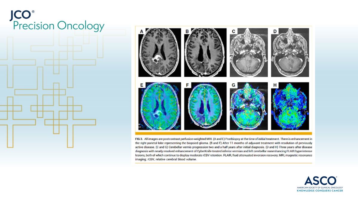 #JCOPO study demonstrates that Pembrolizumab leads to a durable response in an ultra-hypermutated, high-grade, #glioma with complete radiological response that was sustained for more than 2 years. ➡️ brnw.ch/21wHu49 @Dan_Mundt #btsm