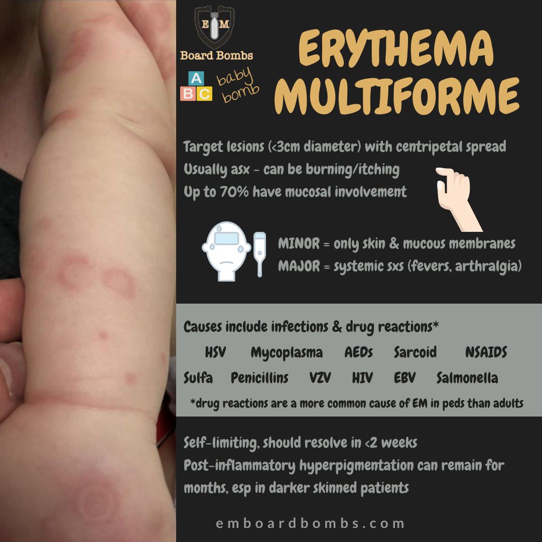 Up to 70% of erythema multiforme cases have mucosal involvement - on the lips and mucosal surfaces, non-attached gingiva, and tongue (but not the pharynx)