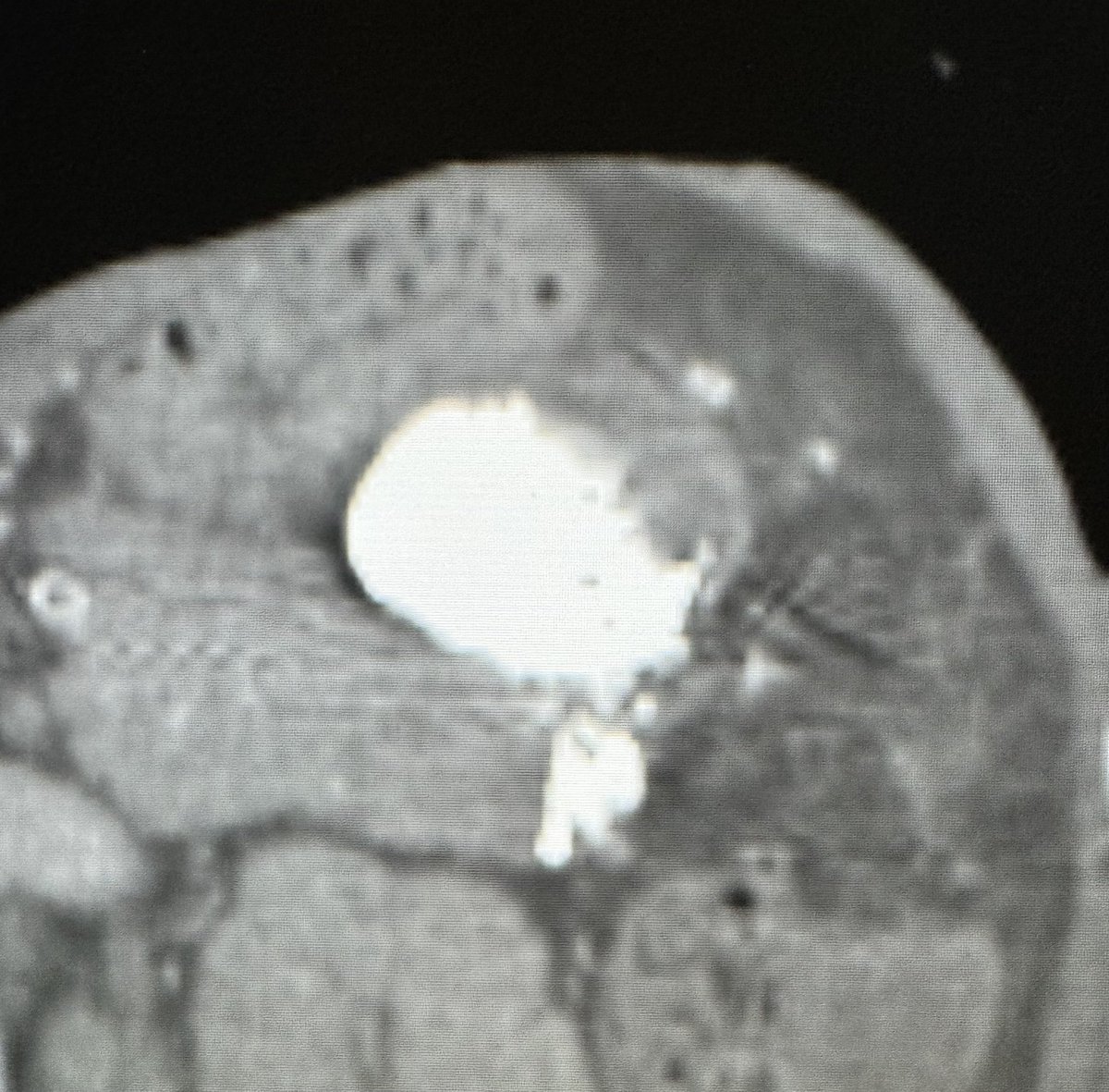 Splenic artery aneurysm post previous prox embo. Multiple inflow/outflow. #Transradial #justglueit via collateral for definitive tx w/o splenectomy. Need more experiences for others to learn benefits of liquid embolics in peripheral space #irad @SIRspecialists @SIR_ECS @SIRRFS