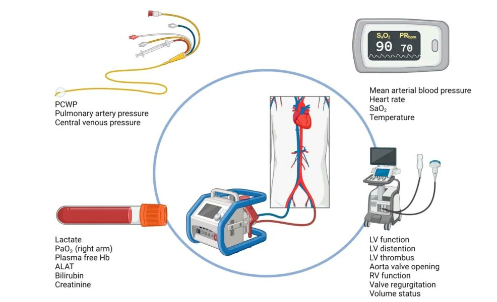 💡🫀ICOT consiglia: paper of the week🫀🧠 💡Monitoring MCS patients on the intensive care unit: integrating haemodynamic assessment, laboratory data, and imaging techniques for timely detection of deterioration and recovery 💡 ❗️Leggi il paper academic.oup.com/eurheartjsupp/…