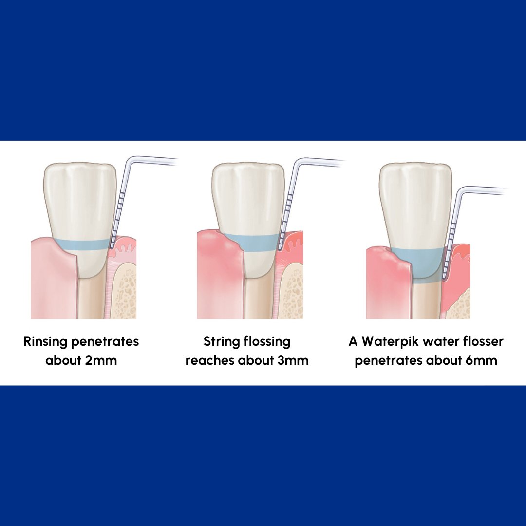 Have you ever wondered if there is a difference between rinsing with mouthwash, string flossing and using a WATERPIK water flosser? Spoiler alert...there is! The WATERPIK water flosser penetrates about 6mm into the gums, whereas string flossing reaches about 3mm.
