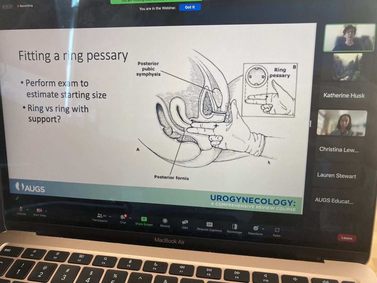kmenhaji_md's tweet image. What tricks do you have for #pessary fitting?

Dr. @ChrisHongMD and Leah Barker, NP discuss all things #pessaries!

@urogynsociety Comprehensive Review Course Day2!!