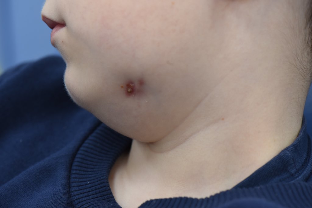 This is an extra-oral draining sinus resulting from a decayed 🦷

This child has had to go to school for 6 months with a plaster on his face to avoid ridicule whilst his family struggled to access care.

Anyone still want to tell me that we’re not failing our kids?