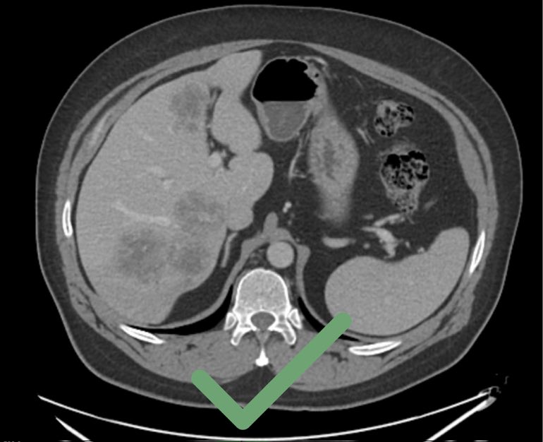 #CAMINO trial showed a 31% change in Tx plan after MRI in pts with #CRLM. BUT suboptimal CT was used for comparison.
Optimal imaging should include high-quality multiphasic CT, with MRI as complementary modality #oncsurgery shorturl.at/abxIQ
<a href="/IHPBA/">IHPBA</a> <a href="/EAHPBA/">E-AHPBA</a> <a href="/AHPBA/">AHPBA</a> <a href="/SSATNews/">SSAT</a>