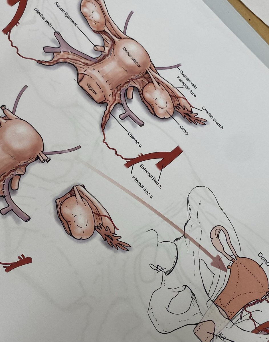 Some interesting transplant projects in the works. ⁦<a href="/BCM_Surgery/">BCM_Surgery</a>⁩ ⁦<a href="/DrRosengart/">Todd Rosengart, MD</a>⁩ ⁦⁦<a href="/ronaldcottonmd/">Ronald T Cotton, MD, FACS</a>⁩