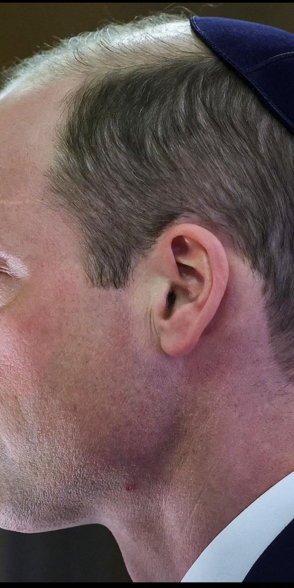 That looks like a nasty bruise 😳