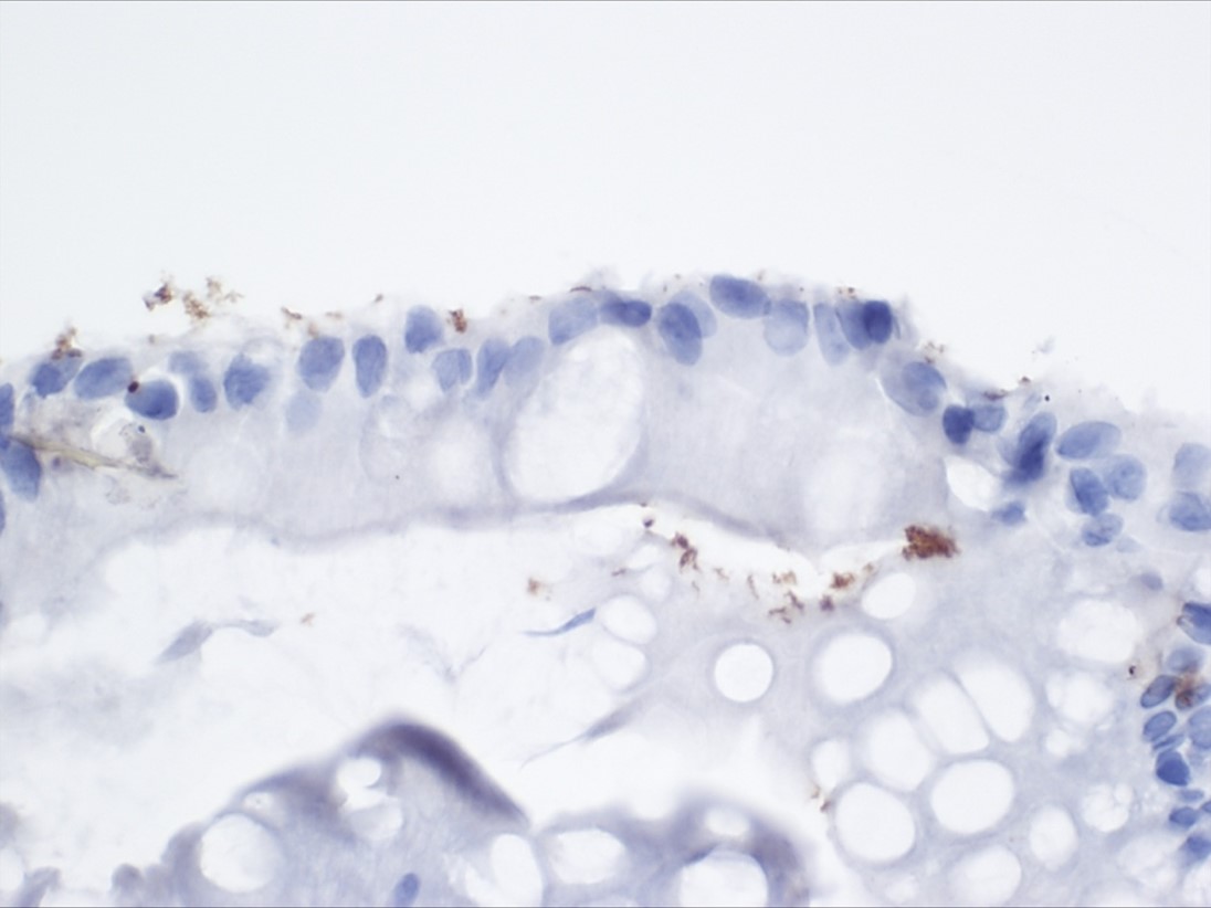 February #COTM is now available on our website. An 80 yo F with CVID; gastric biopsy; IHC for H. pylori is positive but patient did not respond to Rx earlier. usgips.com/resources/case…… #pathology #GIpath