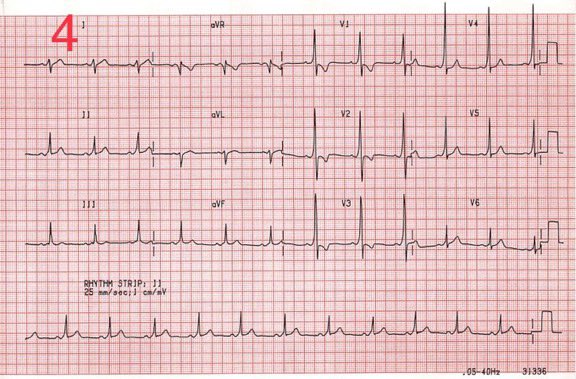 md1talk's tweet photo. كويز ECG 🫀

وش التشخيص لكل رقم ؟!!! https://t.co/FYooJjJ3Yc