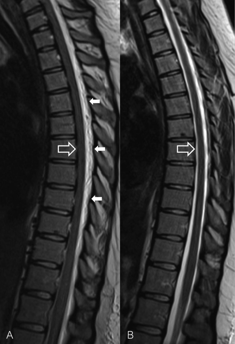 Case report: 🚩Spinal cord compression is a rare complication of an inadvertent dural puncture (ADP) due to CSF leak into epidural space 🚩Consider neuro-imaging for symptomatic patients #ObAnaes #ObAnes