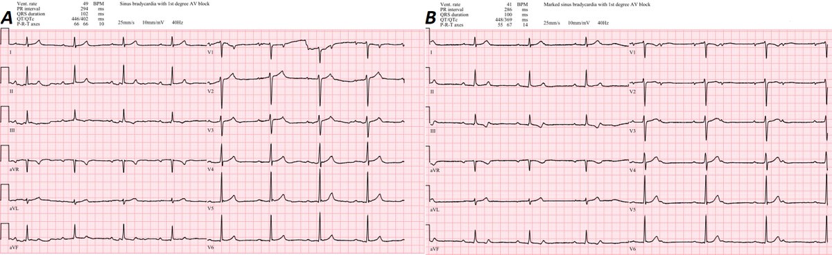 Yuksek Ihtisas Arrhythmia- Ankara City Hospital tweet media