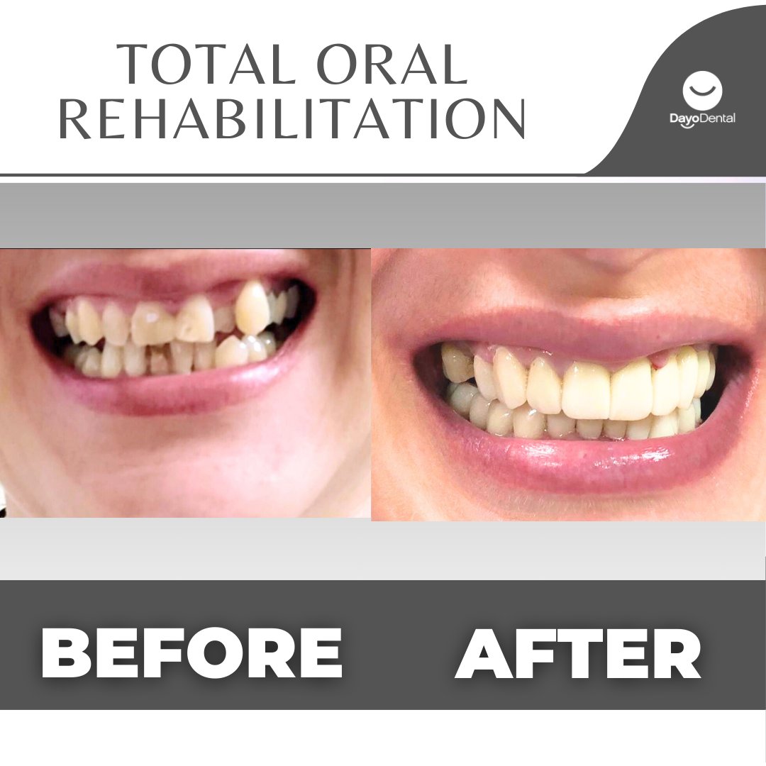 YES, your smile can be fixed! 
𝑻𝒐𝒕𝒂𝒍 𝙊𝒓𝒂𝒍 𝒓𝒆𝒉𝒂𝒃𝒊𝒍𝒊𝒕𝒂𝒕𝒊𝒐𝒏 combines procedures like dental implants and crowns, personalized to address specific oral issues. To restore function, enhance aesthetics, and improve overall oral health. #oralrehabilitation