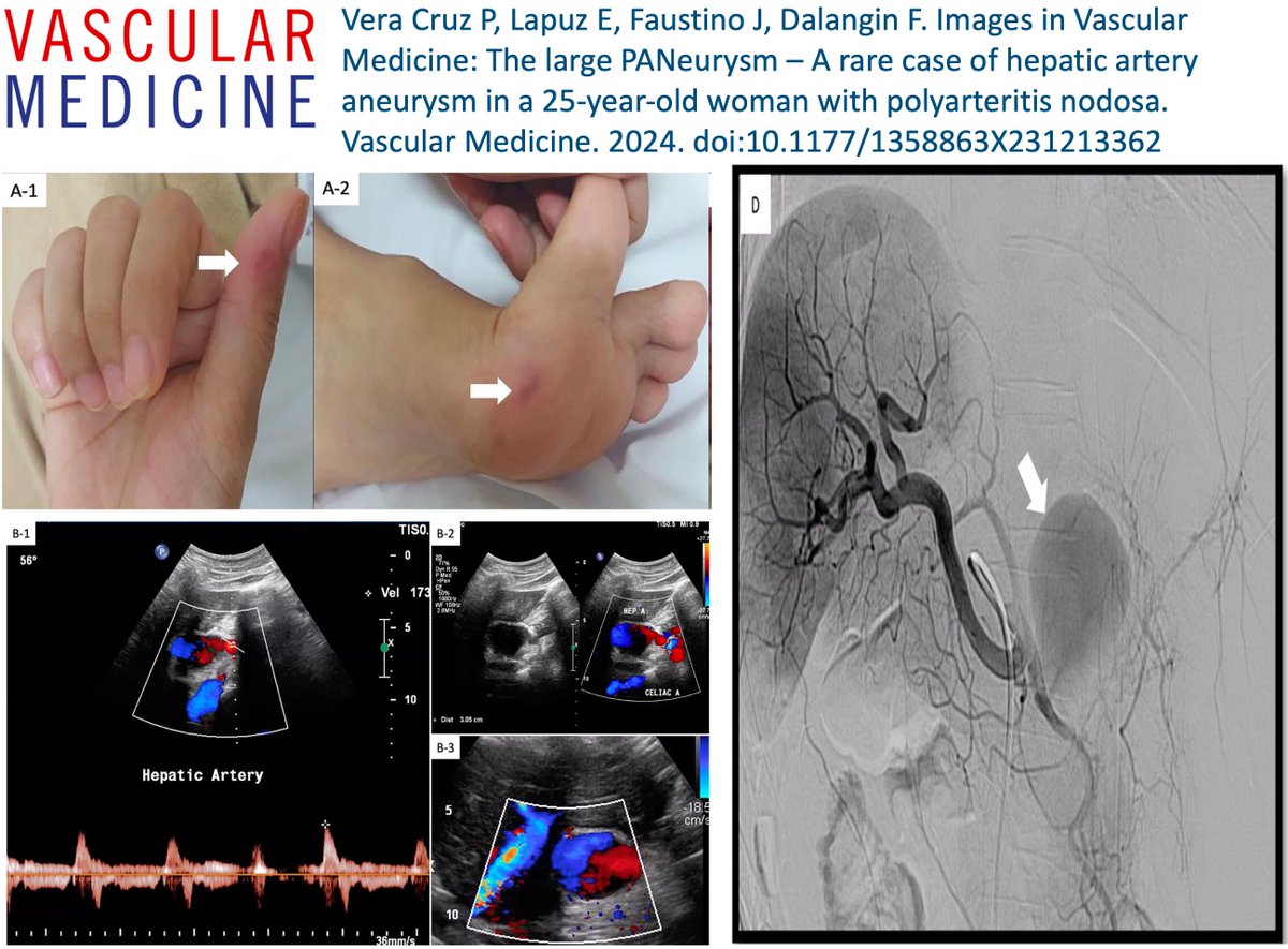 A 25-year-old, previously healthy, female presented with recurrent cramping abdominal pain, lower-extremity discomfort, nausea and vomiting. Read about complications of polyarteritis nodosa and their management in these #ImagesinVascMed by Cruz et al. buff.ly/3TiuGOL