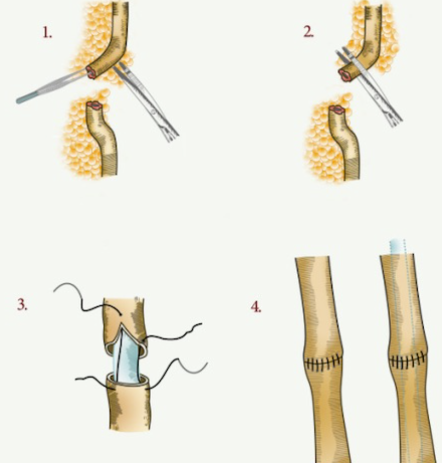 PRINCIPLES OF URINARY ANASTOMOSES:

Spatulated (⬆️ mucosal surface)
Watertight (🚫 leak)
Absorbable suture (nidus for stones)
Stented and drained (🚫 leak) 
Tension free (🚫 ischemia)
Well vascularised, healthy tissue (🚫ischemia)
Mucosa to mucosa

What suture do you use?