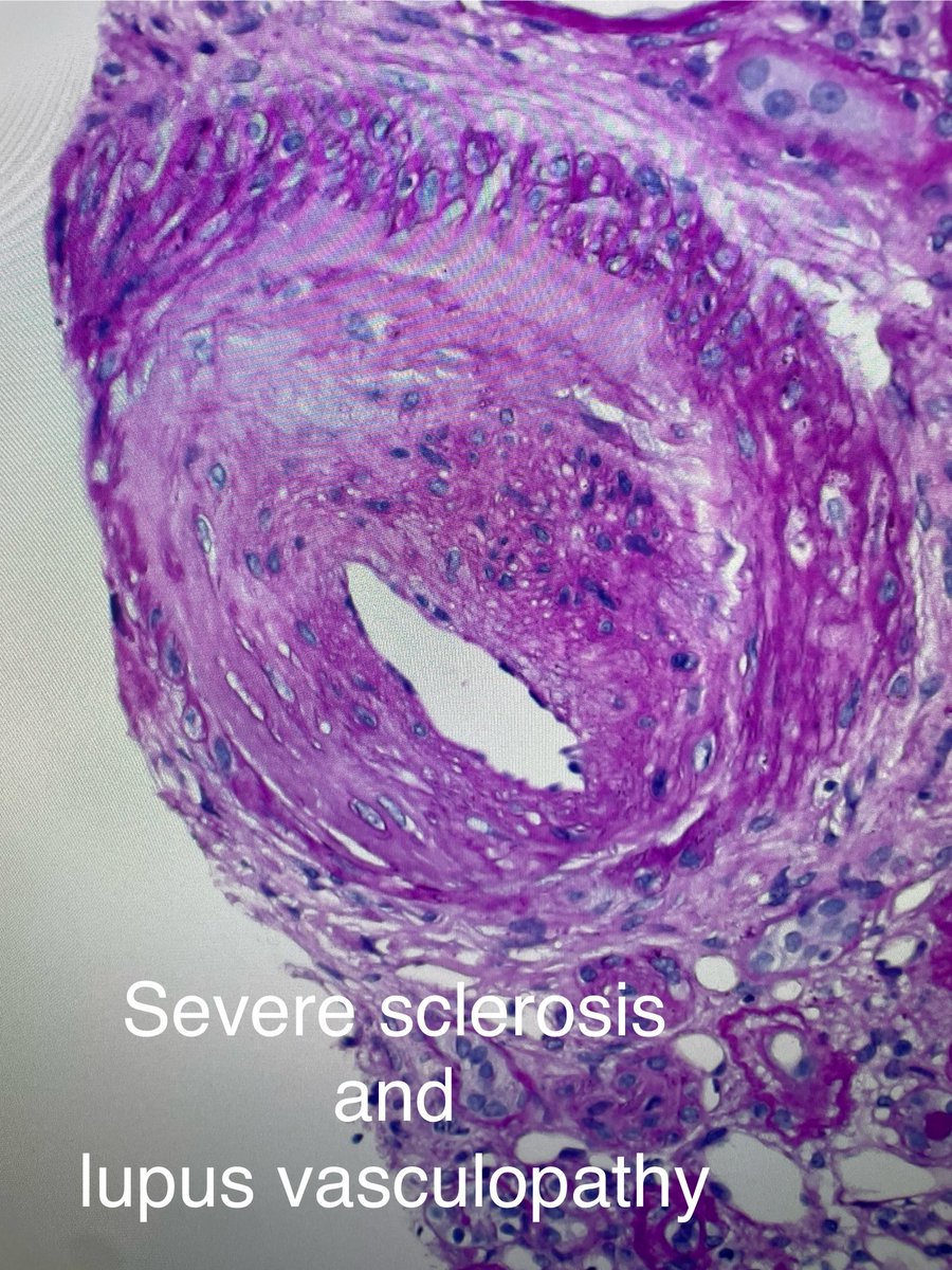 1. Focal necrotizing lupus arteritis. Plus severe lupus vasculopathy. Can be missed and is unfortunately not part of the lupus classification. 2. Glomeruli showed mesangial lupus nephritis, class II. 40-yr old woman with lupus & rise in serum creatinine,+ lupus anticoagulant.