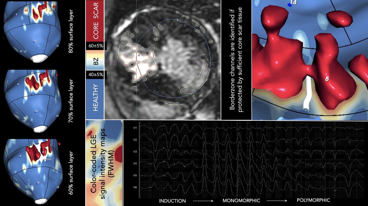 The impact of scar architecture on ventricular arrhythmias in hypertrophic cardiomyopathy. #HCM #VT Cardiac Imaging Scar Characterization by @DrBerruezo @pietro_francia @diegopenela1 @Davidsotoiglesi @julio93383971 @ADAS3D doi.org/10.1093/europa…