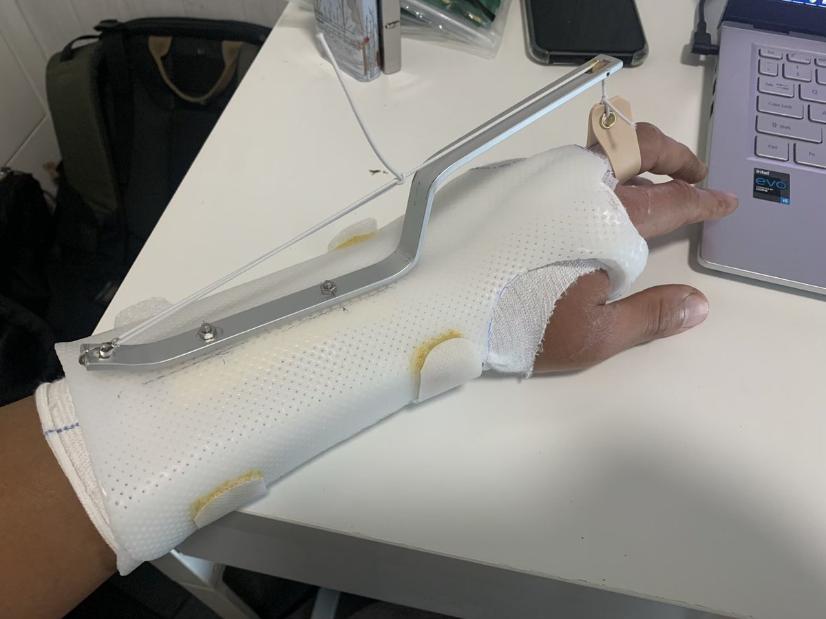 BrightBirdBio's tweet image. 轉變

兩個星期前不小心弄傷了左手筋腱，幸好即晚就能在醫院做手術，加上服用了順勢療法的療劑，傷口的癒合總算理想，十分萬幸感恩。

但始終傷勢不輕，三個月也不能用左手務農，很多要用雙手的簡單工作如挑坑也未能處理。正當躊躇著…

brightbirdbio.com/?p=3420