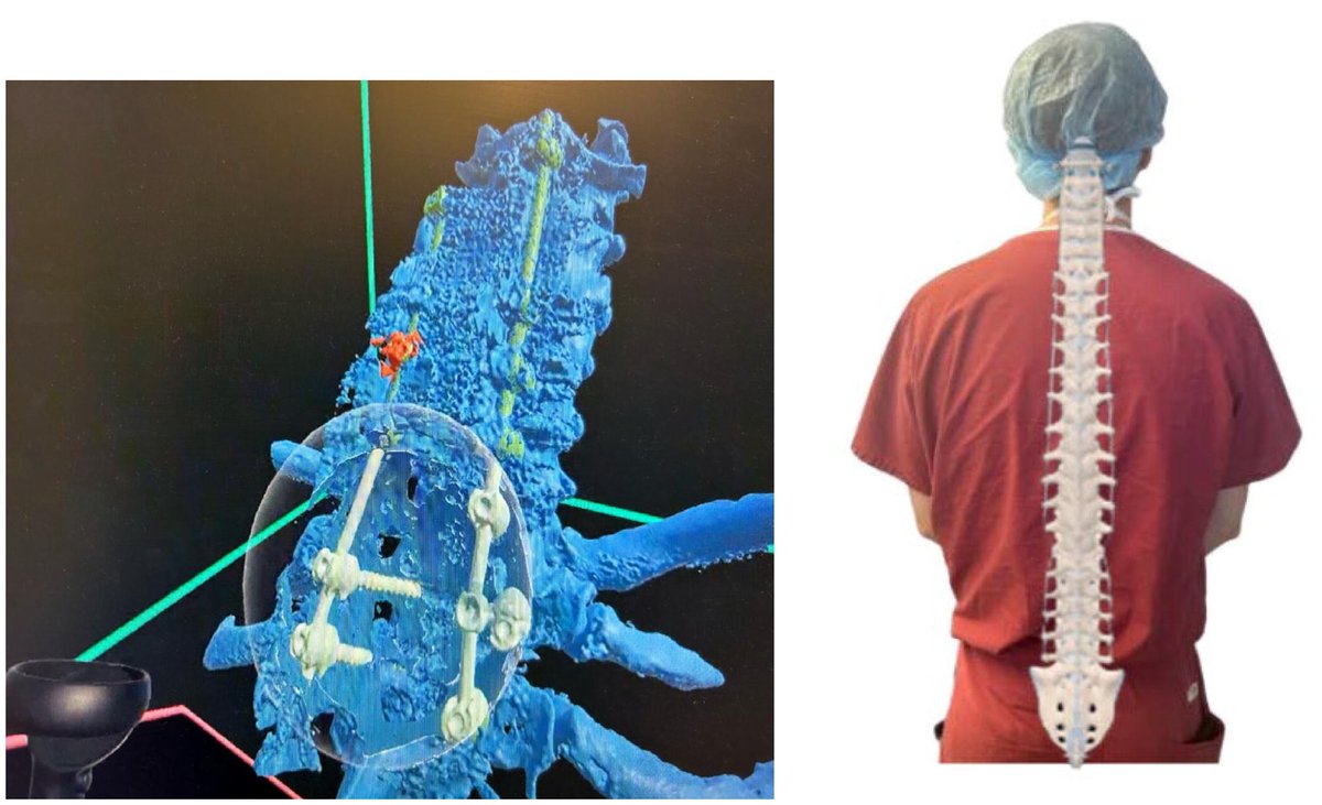 Obstetric anesthesiology and extended reality: an introduction to future uses of spatial computing in #ObAnes 💻Simulate procedures 💻Real time guidance 💻Limitations of feasibility, cost, obtaining imaging @rohan_jotwani @JohnERubinMD @RobertWhiteMD obstetanesthesia.com/article/S0959-…