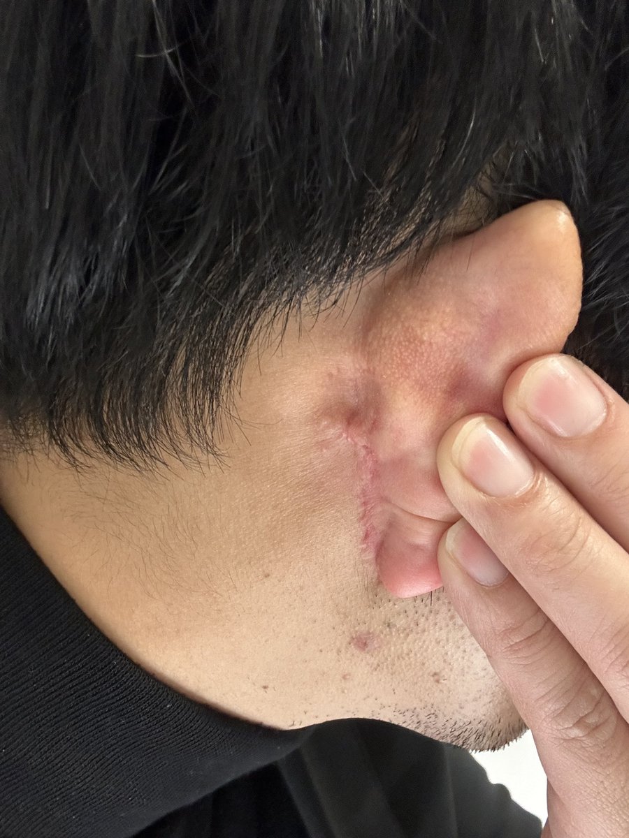 冬になると、傷口が痒くなります。今まで以上に耳が冷たくなるし、痛い

そして、傷口が痒い。。。

#rex 
#切開リフト 
#バッカルファット 
#メーラーファット
#整形垢 
#韓国 
#整形
#ANA
#voco
#ダウンタイム
#メンズ美容
＃ほうれい線