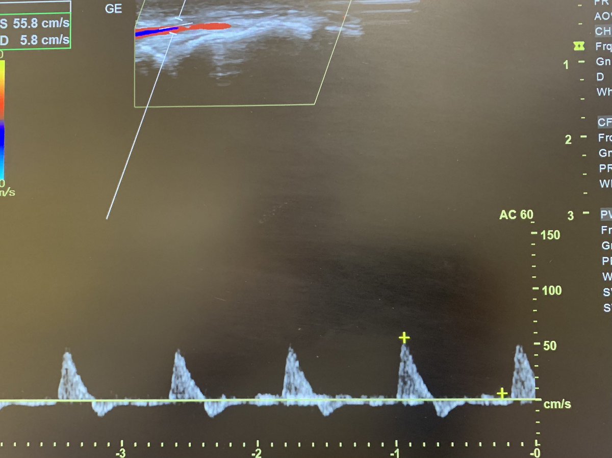 Case 36: Spot diagnosis
.
54/F; diabetic, HTN, migraine
2D echo: normal
Clinical image 👇
Aortogram - no plaque/aneurysm
Doppler - normal triphasic flow ATA/DPA/PTA
.
#MedTwitter #CardioTwitter #MedEd #MedX #clifighters @nihardesai7 @PanktiMehta24 @VascularForum @_backtable