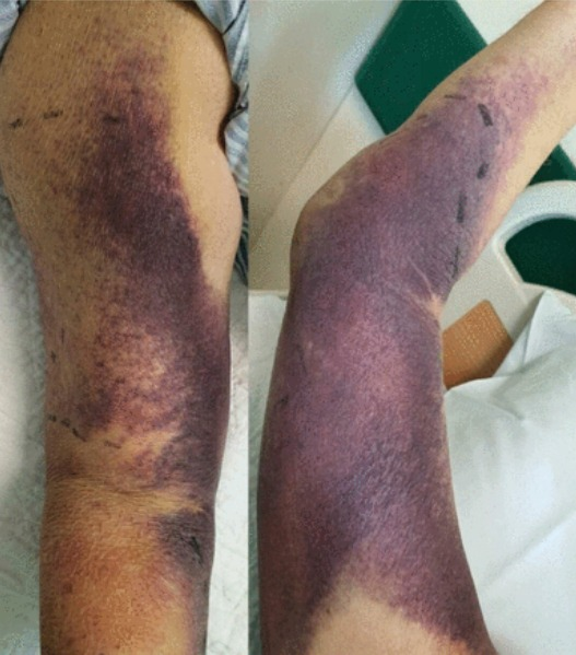 Case of acquired haemophilia following Pfizer

A man in his 80s developed multiple bruises 2 weeks after the first dose of #Pfizer #mRNA vaccine.

His second dose of the  vaccine was deferred

casereports.bmj.com/content/15/3/e…