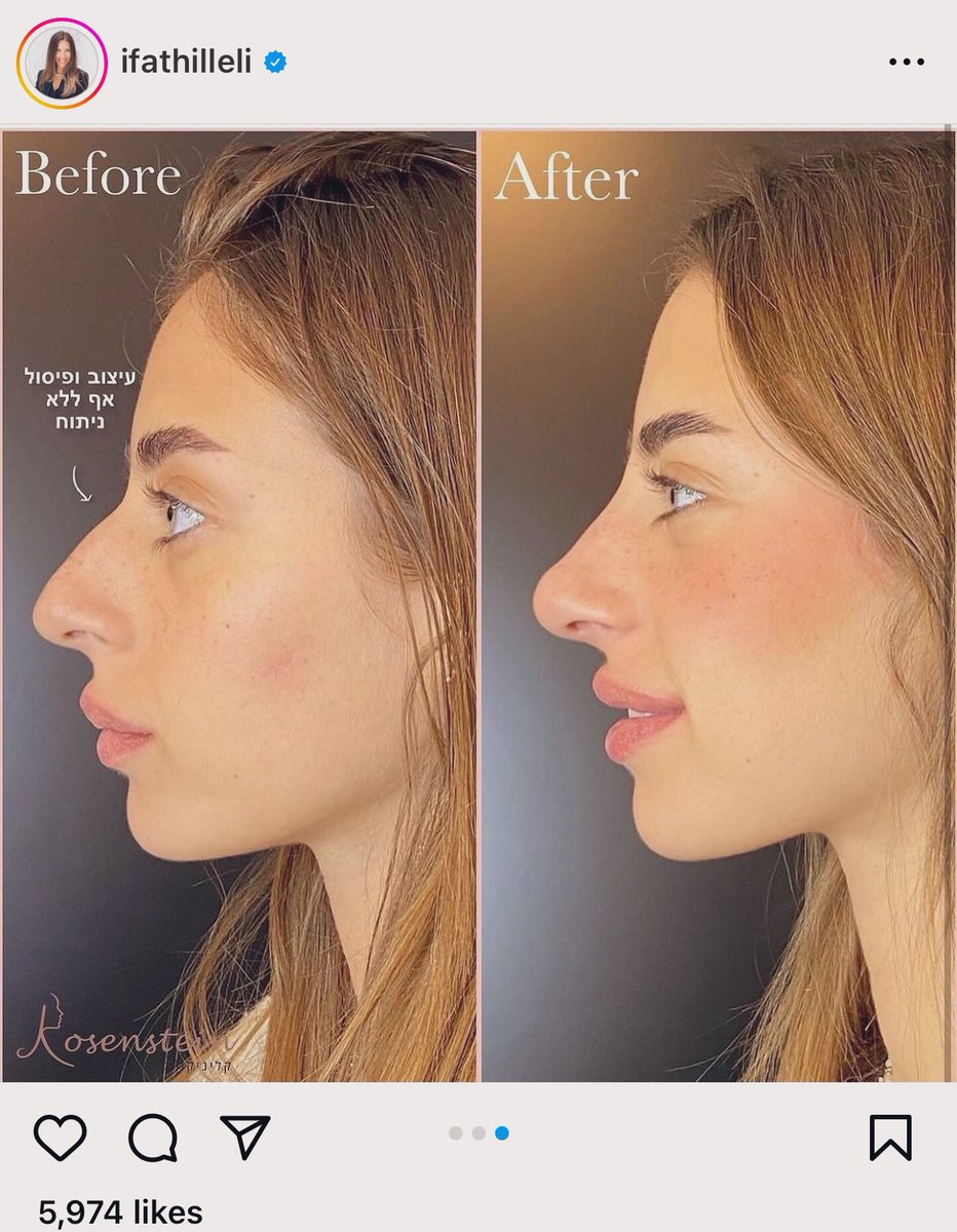 HadiNasrallah's tweet image. Remember her? While Palestinian hostages are being crushed by Israeli tanks, released Israeli hostages are out there getting nose jobs. That doesn’t look like a person who “went through hell”.