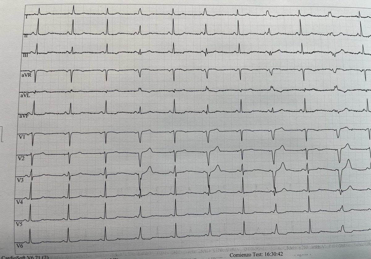 Rhythm? #ECG #CardioTwitter @MaruanCarlos @martinfd78 @carprimur @CardioAPFerrol @chuletadeosler @MedicalumRCC @cardiotipss @EM_RESUS @PasionAnatomia @ACH_epteam