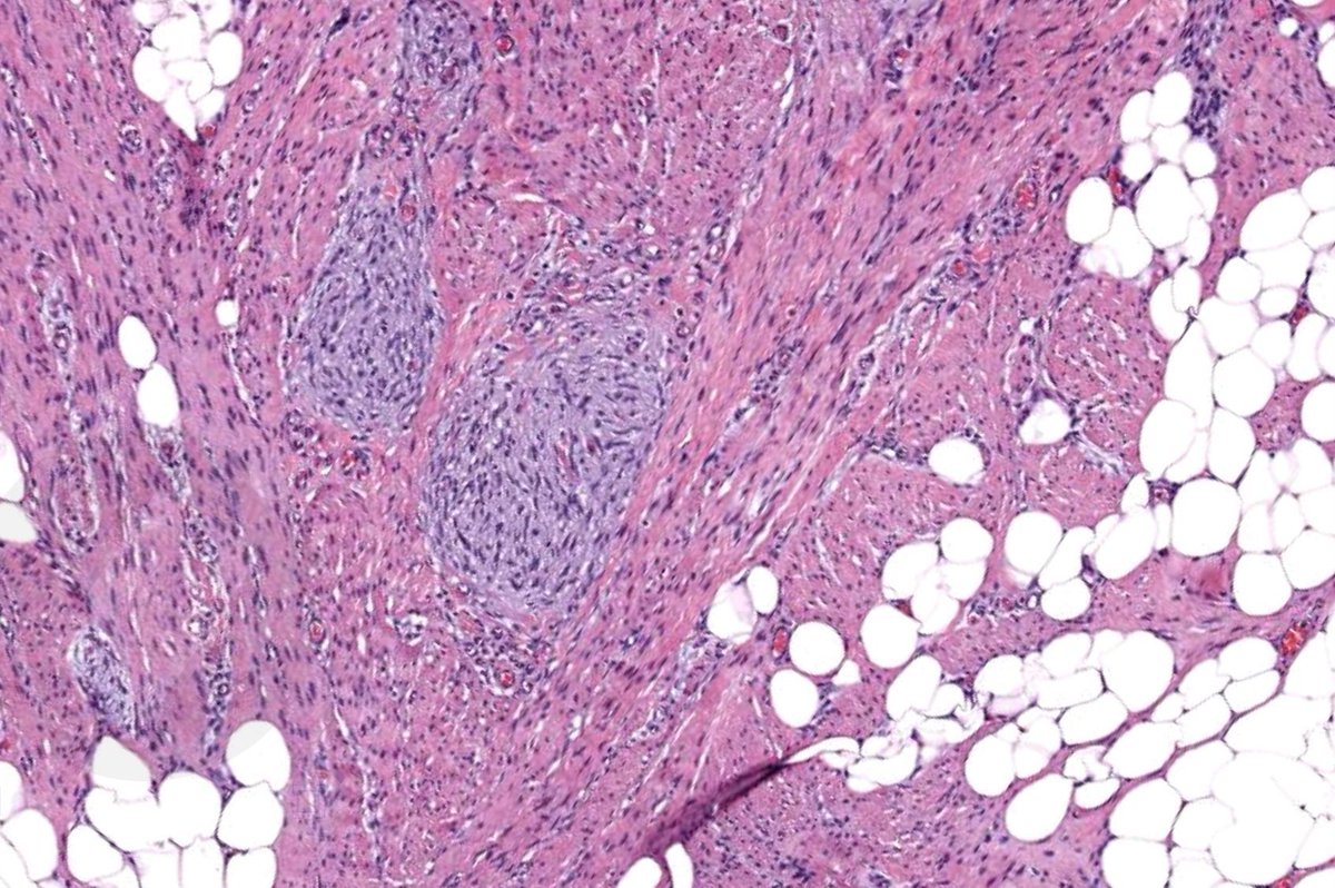 Can you get this diagnosis from one pic? Or is it too close to diagnose? WSI digital slide: kikoxp.com/posts/8206. Answer & video: youtube.com/watch?v=GZ-s95… #pathology #pathologists #pathTwitter #dermpath #dermatology #dermatologia #dermtwitter #bstpath #pedipath