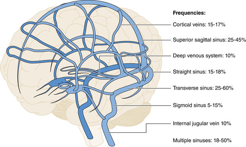 Diagnosis and Management of Cerebral Venous Thrombosis: A Scientific Statement From the American Heart Association | Stroke ahajournals.org/doi/10.1161/ST…