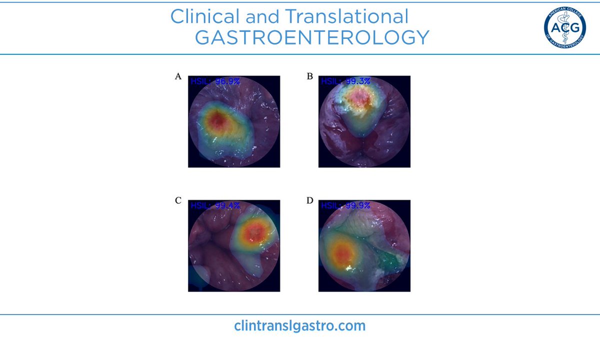 In #CTGjournal: Deep Learning in High-Resolution Anoscopy: Assessing the Impact of Staining and Therapeutic Manipulation on Automated Detection of Anal Cancer Precursors Saraiva, et al. ➡️ bit.ly/3SXLl95 @AmCollegeGastro @brianjacobsonmd