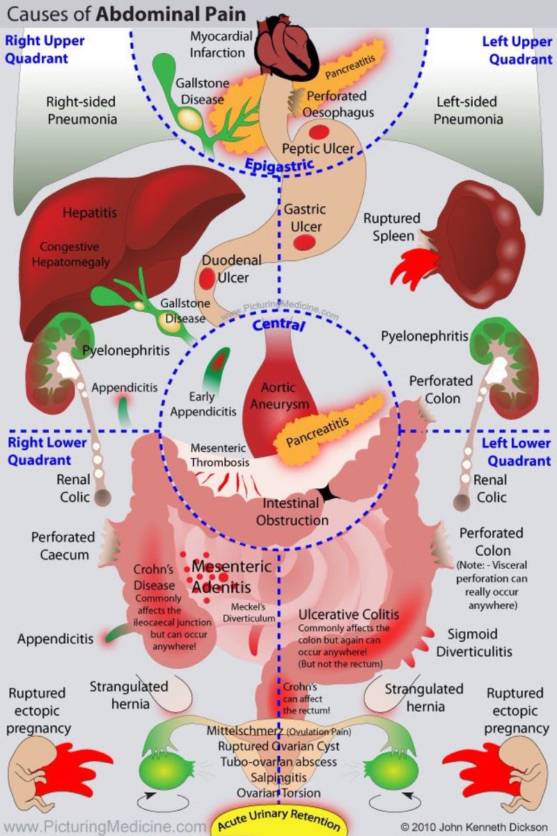 Causes of abdominal pain 

#MedEd #MedX