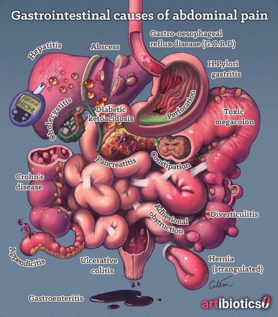 Abdominal Pain

#TipsForNewDocs #MedEd #MedTwitter #medicine #medical #medicare #health #healthcare #FOAMed #ClinicalPearl #clinicaltips #MedStudents #GITwitter #gut #Gastroenterology #pain #MedX